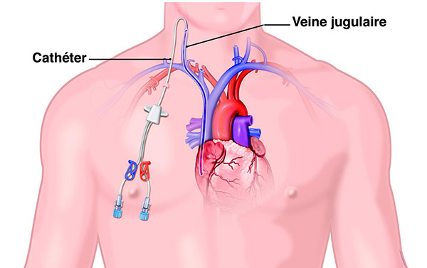 Schéma cathéter veineux
