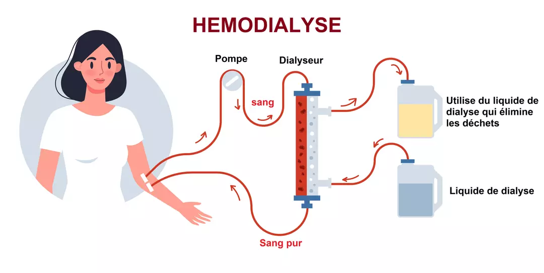 Schéma de l'hémodialyse