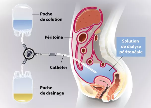 Schéma dialyse peritoneale